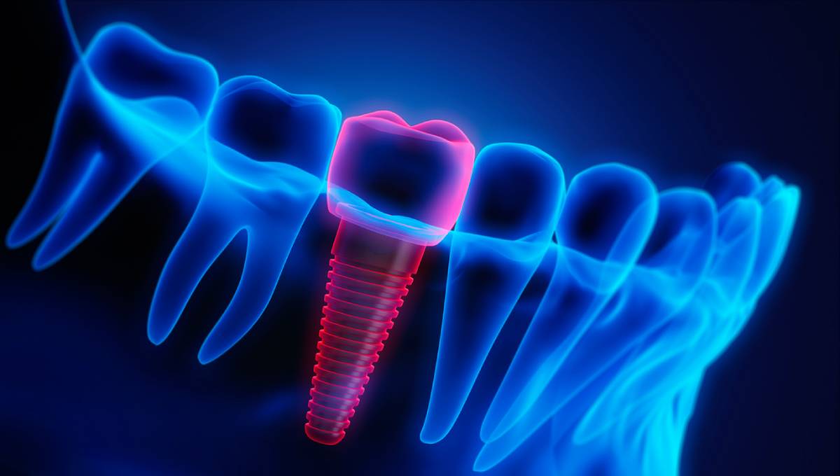 concept of how to clean your dental implants