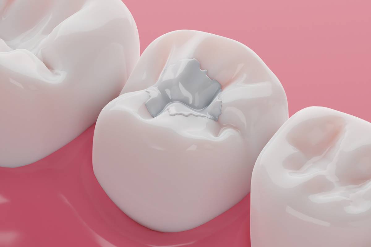 Featured image for How Long Will a Tooth Filling Last?
